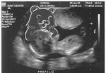  fetus pedobear uterus womb x-ray 