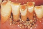  gums humor maggots nightmare_fuel parasite teeth 